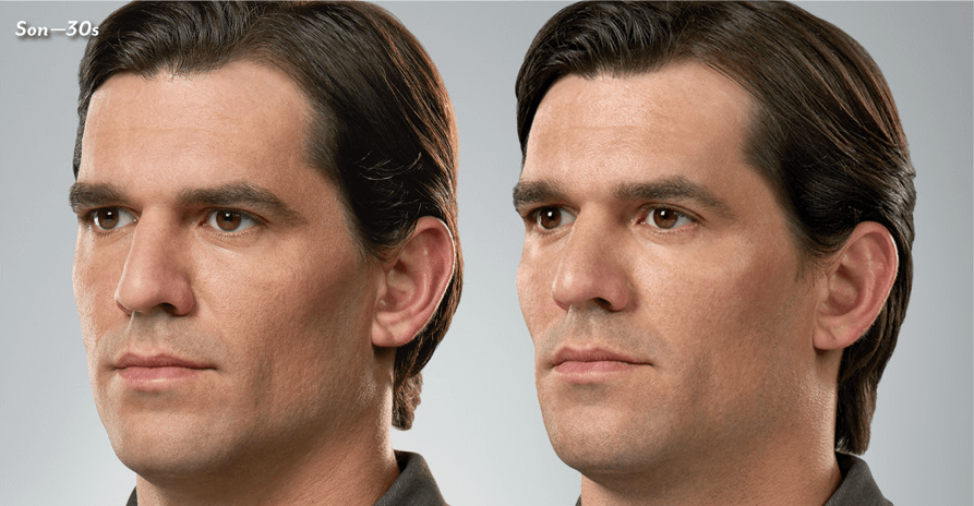 Skin Artisans at Edina Plastic Surgery result — Edina, MN