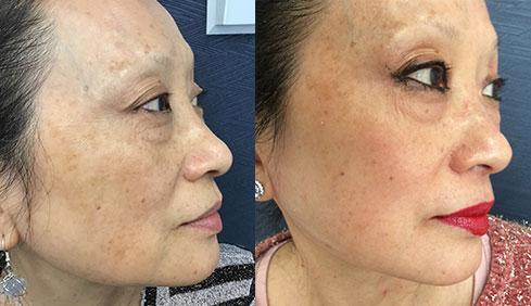 Skin Artisans at Edina Plastic Surgery result — Edina, MN