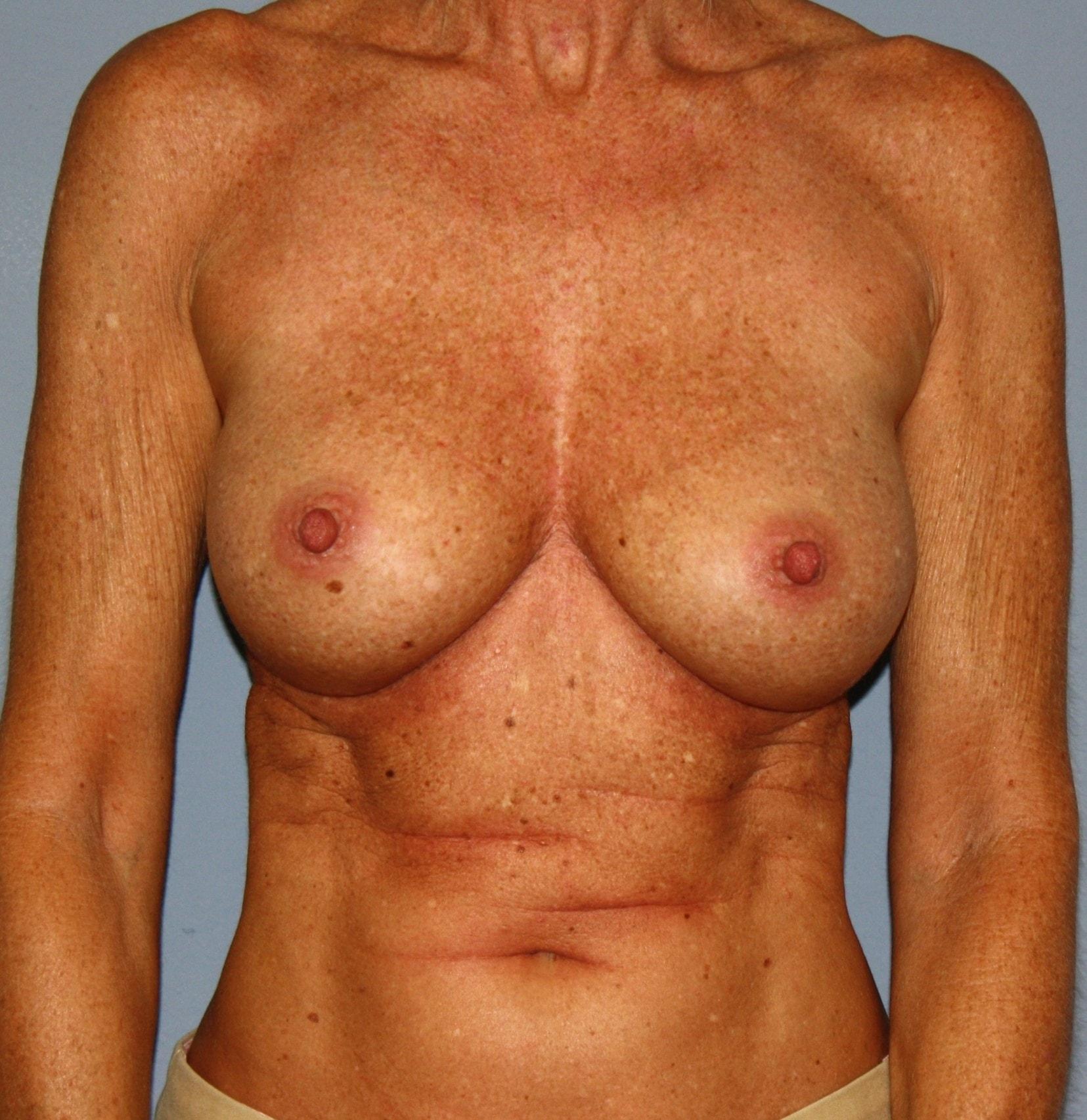 Kyle P. Gordley, MD breast augmentation after — Shenandoah, TX