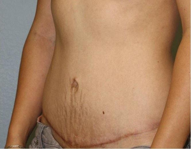 Kyle P. Gordley, MD tummy tuck after — Shenandoah, TX
