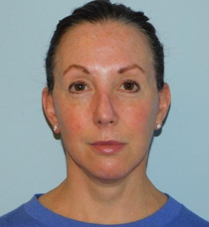 Jonathan Pontell, MD facelift after — Wayne, PA