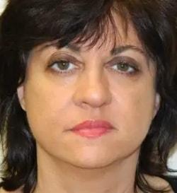 Jonathan Pontell, MD facelift after — Wayne, PA