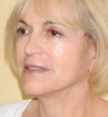 Jonathan Pontell, MD facelift after — Wayne, PA