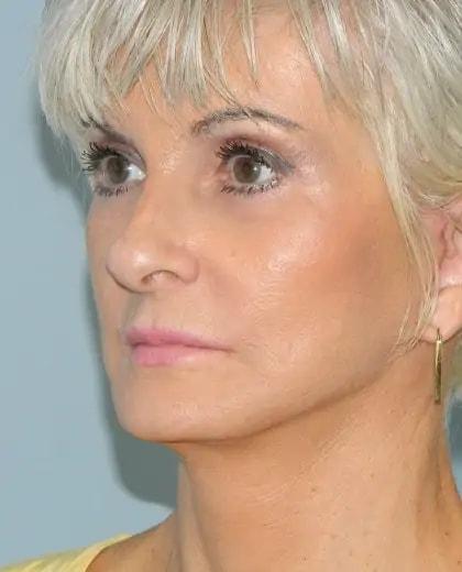 Jonathan Pontell, MD facelift after — Wayne, PA