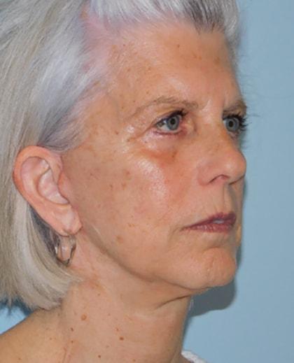 Jonathan Pontell, MD facelift after — Wayne, PA