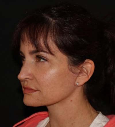 Yael Halaas, MD, FACS facelift after — New York, NY