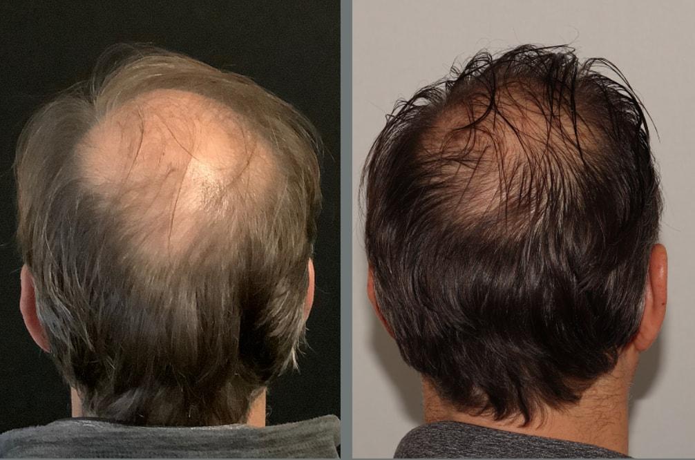 Yael Halaas, MD, FACS hair restoration result — New York, NY