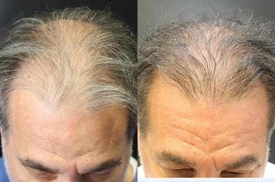 Yael Halaas, MD, FACS hair restoration result — New York, NY