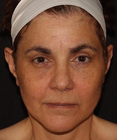 Yael Halaas, MD, FACS facelift after — New York, NY