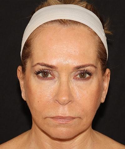 Yael Halaas, MD, FACS facelift after — New York, NY