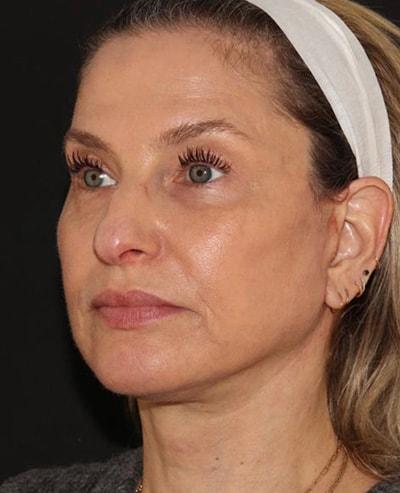 Yael Halaas, MD, FACS facelift after — New York, NY