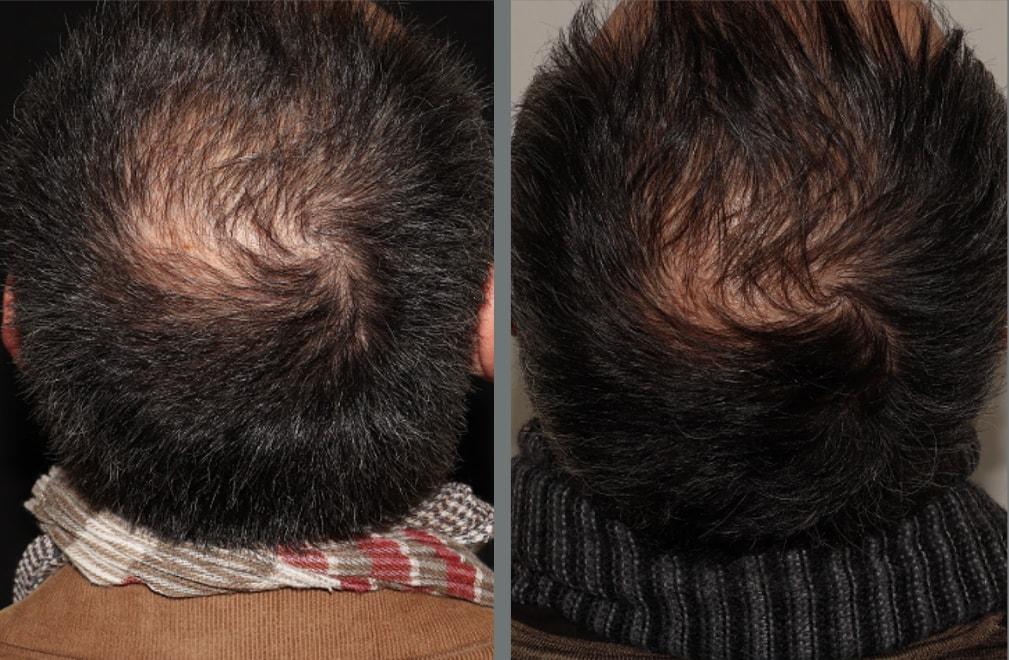 Yael Halaas, MD, FACS hair restoration result — New York, NY