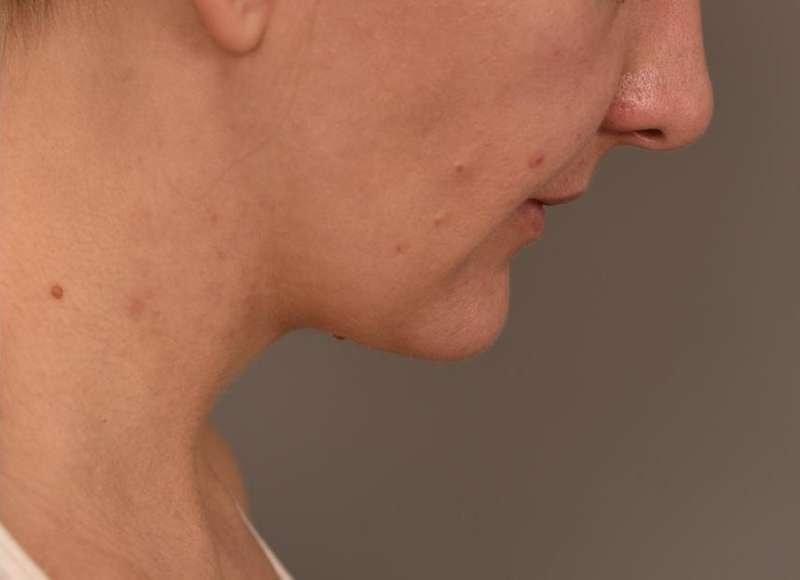 Thomas P. Sterry, MD neck liposuction after — New York, NY