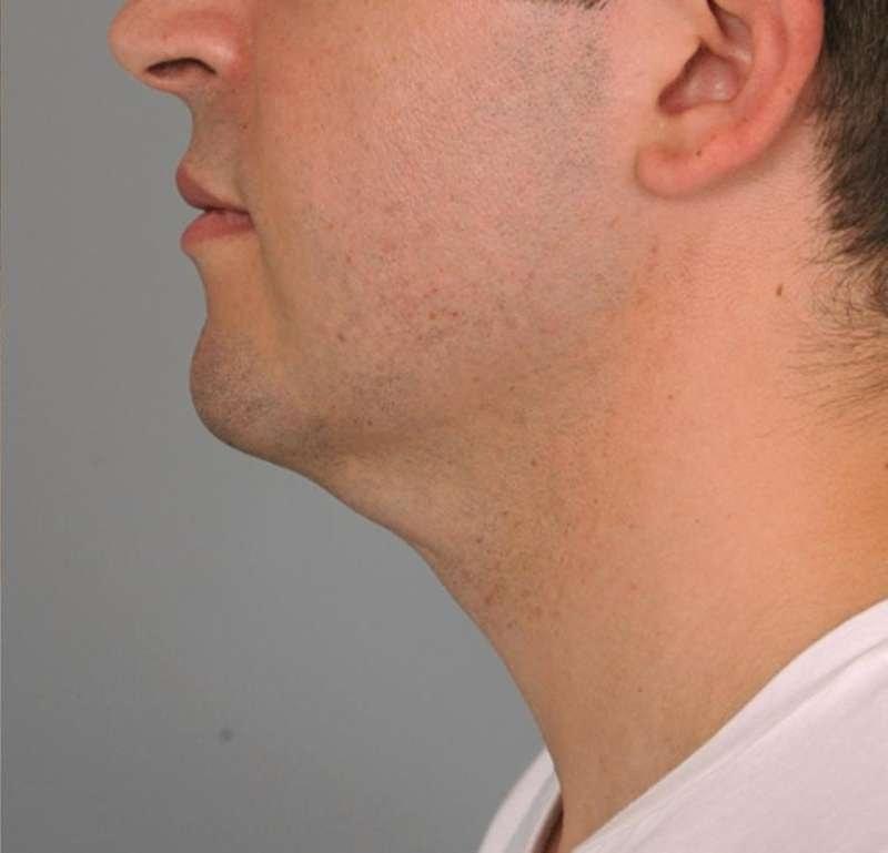 Thomas P. Sterry, MD neck liposuction after — New York, NY