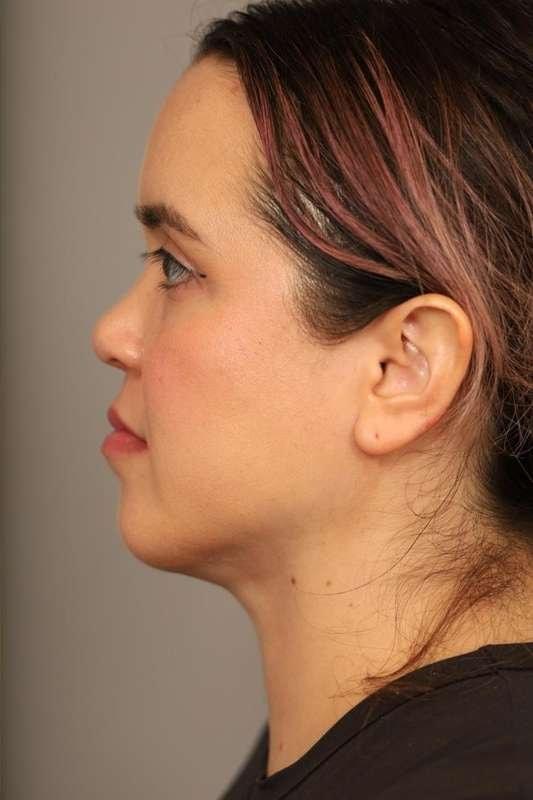 Neck Lift after at Thomas P. Sterry, MD in New York, NY