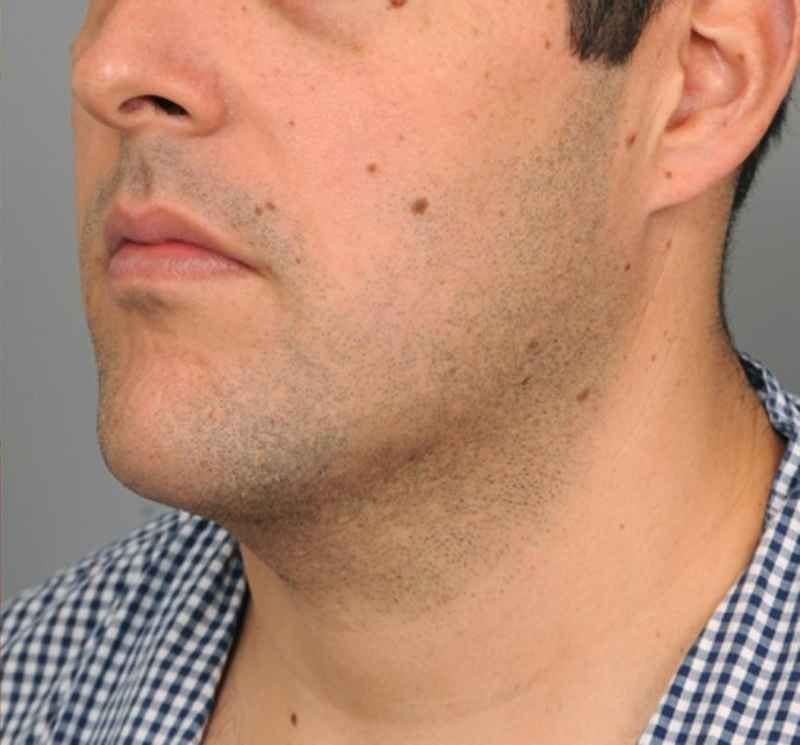 Thomas P. Sterry, MD neck liposuction after — New York, NY