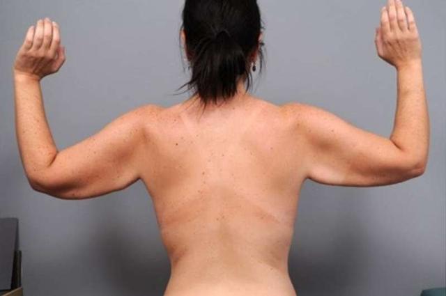 Thigh Lift before at Thomas P. Sterry, MD in New York, NY