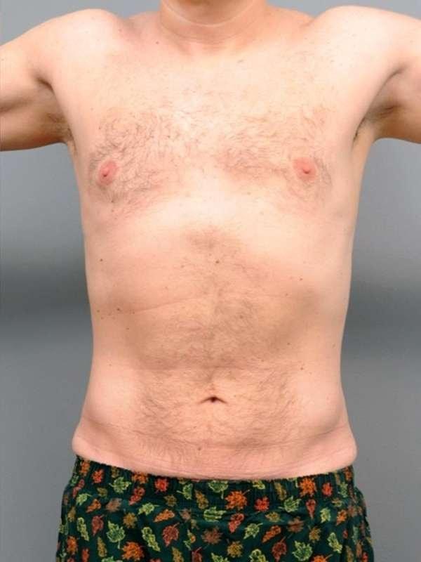 Thomas P. Sterry, MD liposuction after — New York, NY