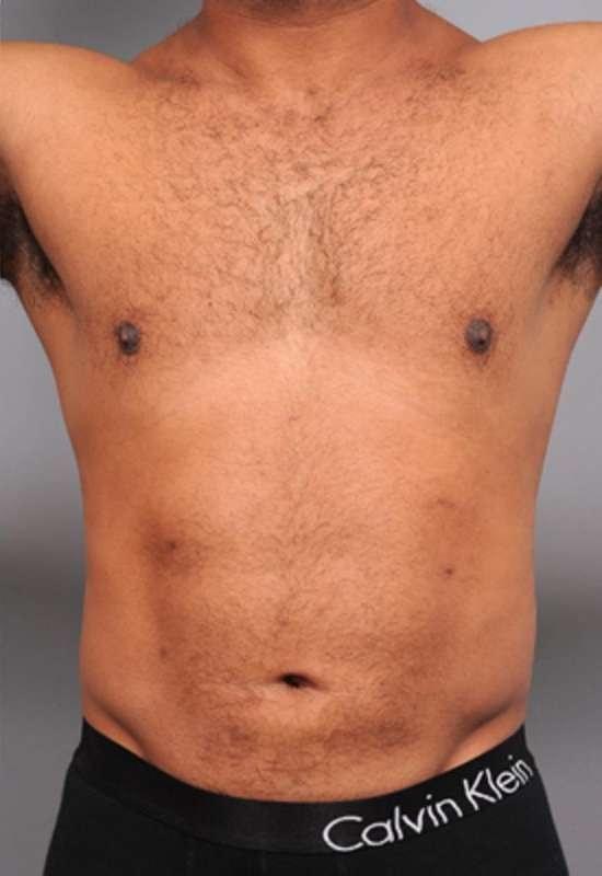 Thomas P. Sterry, MD liposuction after — New York, NY