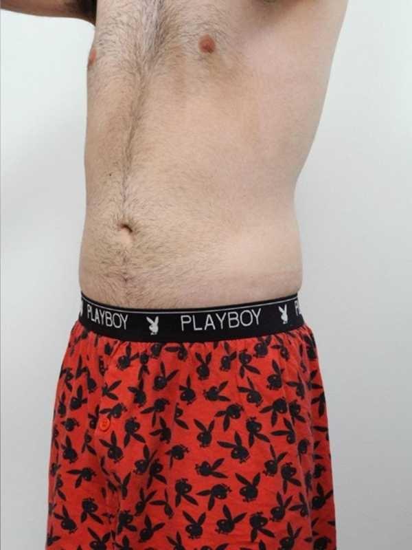 Thomas P. Sterry, MD liposuction after — New York, NY