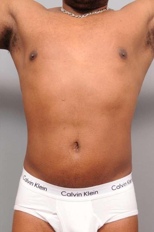 Thomas P. Sterry, MD liposuction after — New York, NY