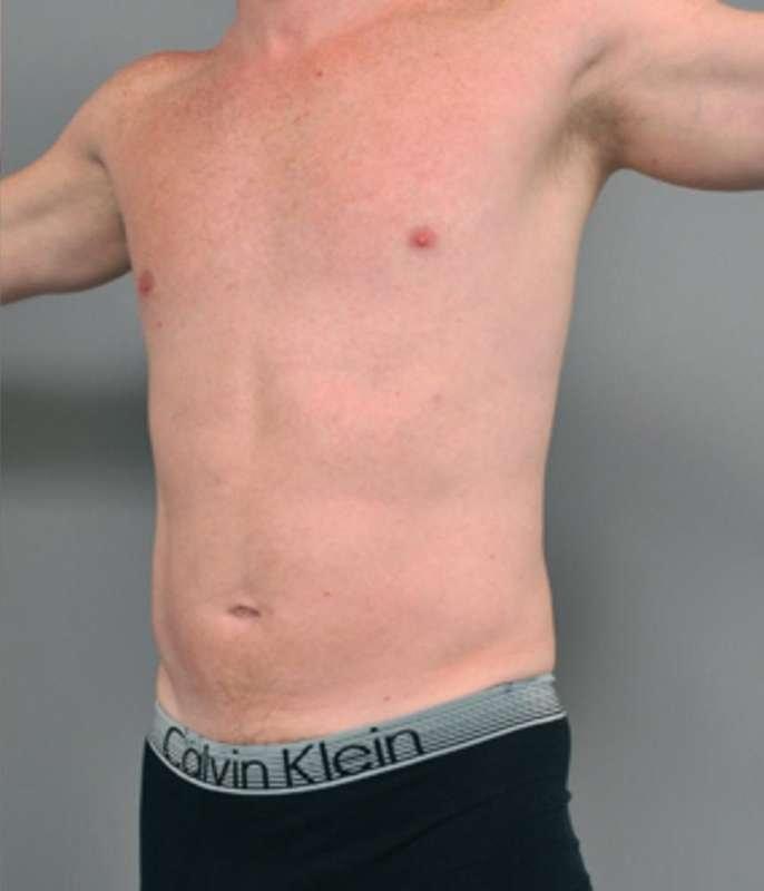 Thomas P. Sterry, MD liposuction after — New York, NY