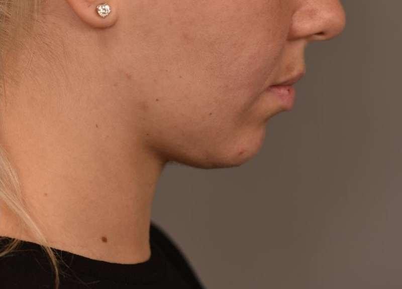 Thomas P. Sterry, MD neck liposuction after — New York, NY