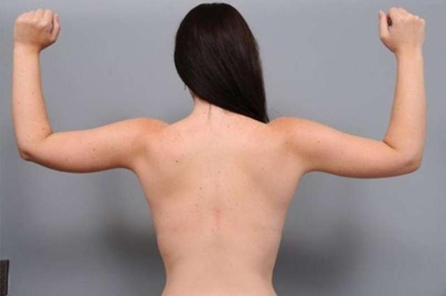 Thigh Lift after at Thomas P. Sterry, MD in New York, NY