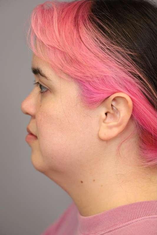 Neck Lift before at Thomas P. Sterry, MD in New York, NY