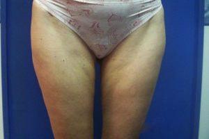 Karen Singer, MD liposuction after — St. Petersburg, FL