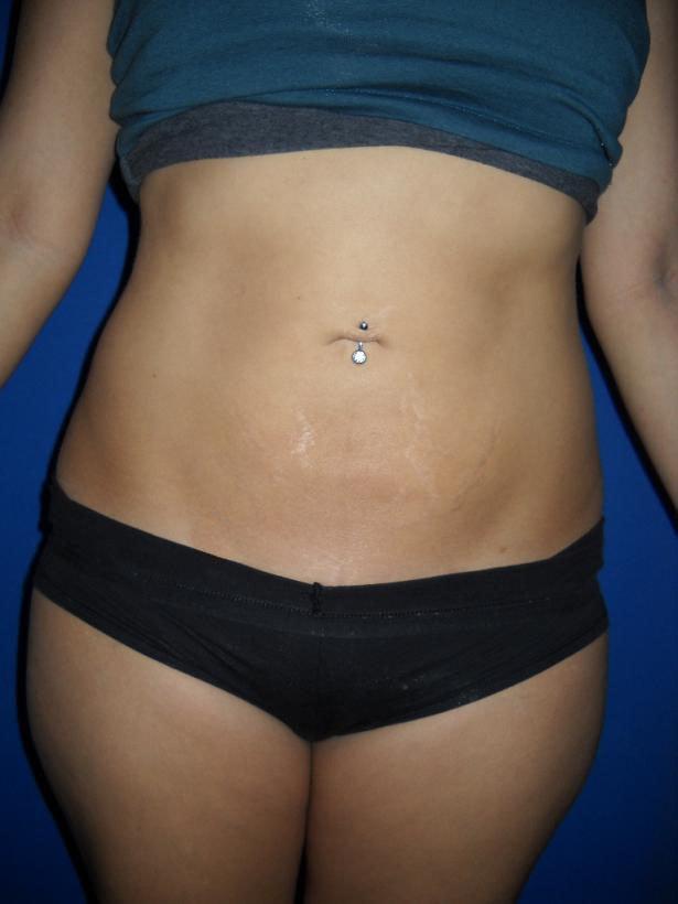 Karen Singer, MD liposuction after — St. Petersburg, FL