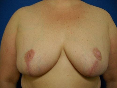 Karen Singer, MD breast reduction after — St. Petersburg, FL