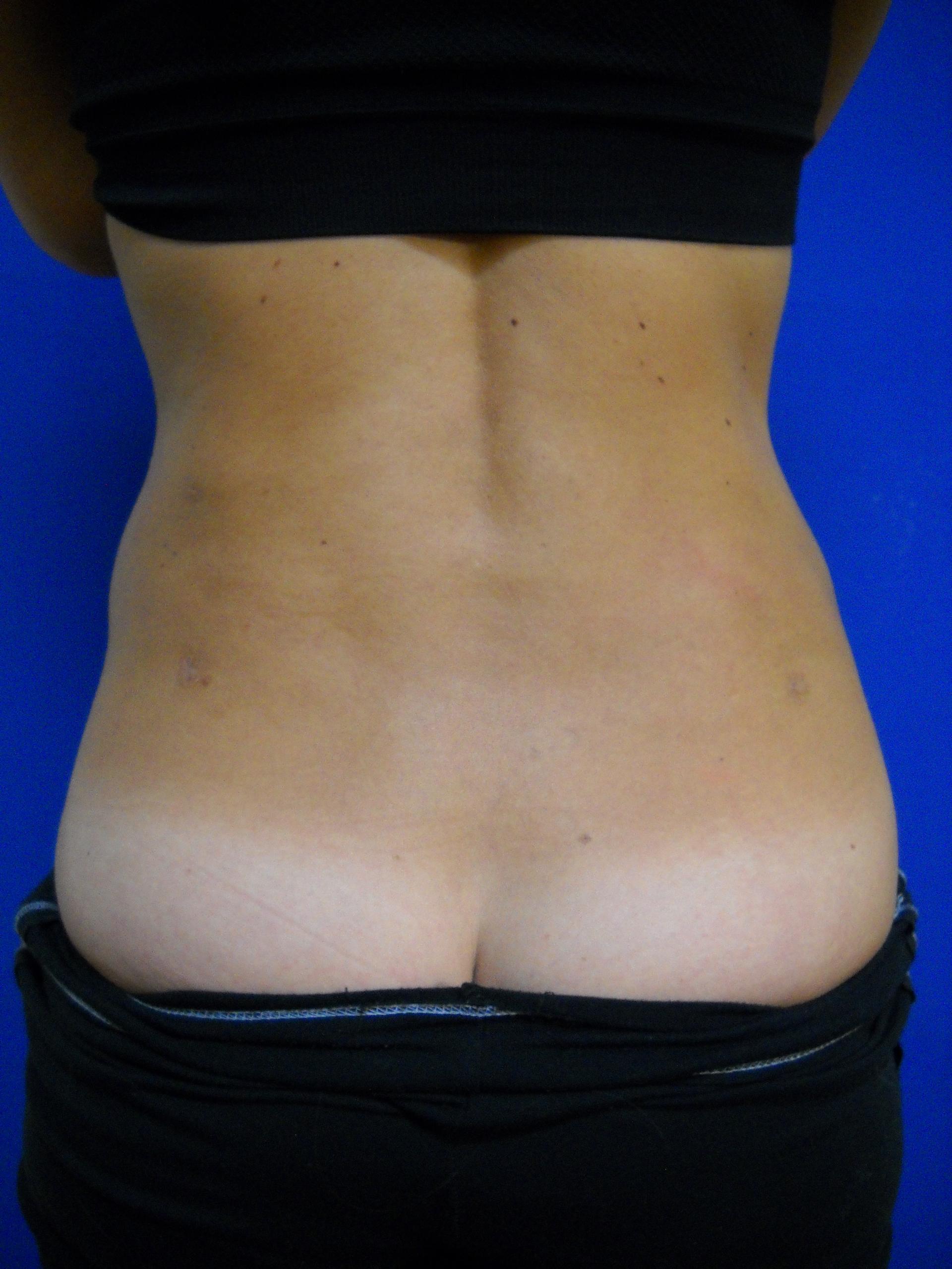 Karen Singer, MD liposuction after — St. Petersburg, FL