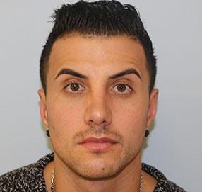 Elias Gikas, MD rhinoplasty after — Chicago, IL