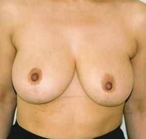 Elias Gikas, MD breast reduction after — Chicago, IL