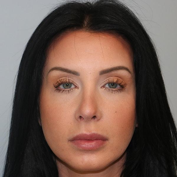 Elias Gikas, MD rhinoplasty after — Chicago, IL