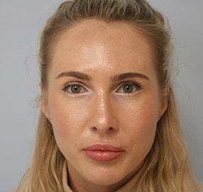 Elias Gikas, MD rhinoplasty after — Chicago, IL