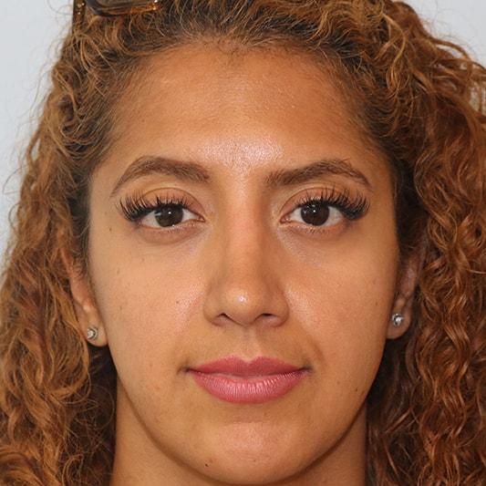 Elias Gikas, MD rhinoplasty after — Chicago, IL