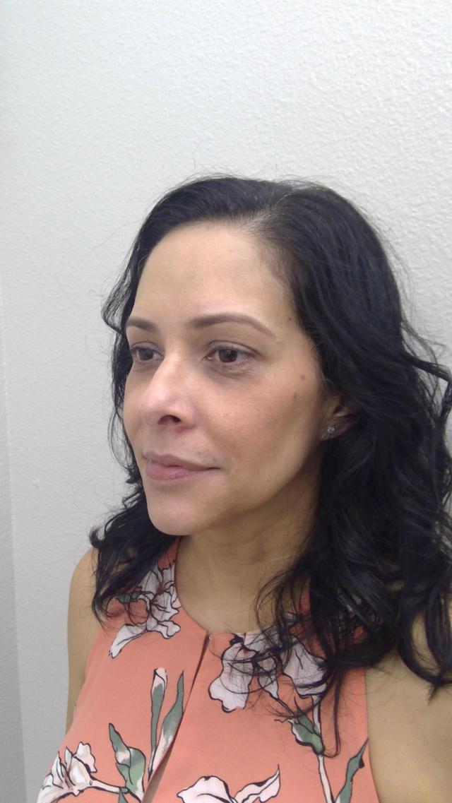 Deep Plane Facelift before at Plastic Surgery Central Florida in Orlando, FL