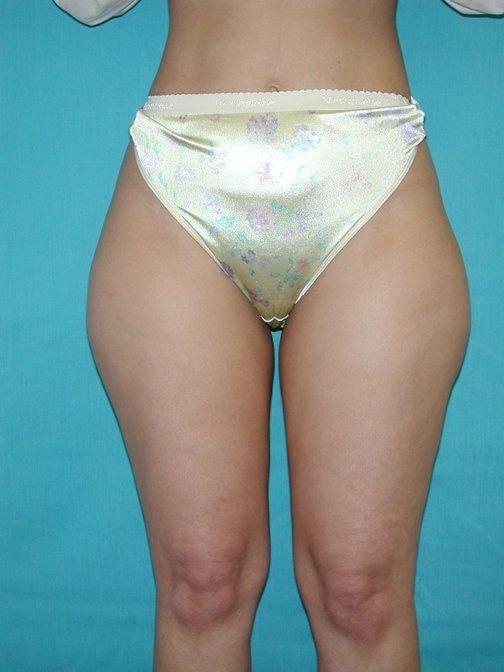 Liposuction before at Plastic Surgery Central Florida in Orlando, FL