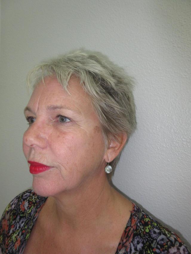 Deep Plane Facelift before at Plastic Surgery Central Florida in Orlando, FL