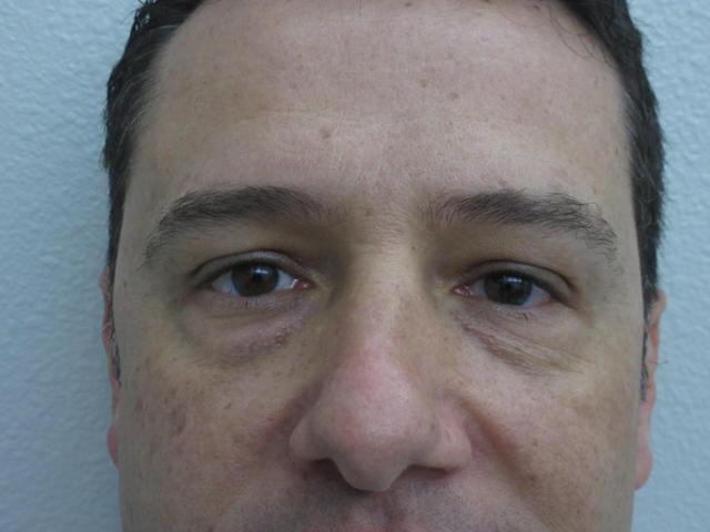 Blepharoplasty before at Plastic Surgery Central Florida in Orlando, FL