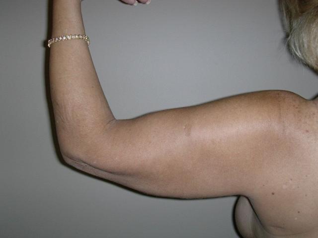 Arm Lift before at Plastic Surgery Central Florida in Orlando, FL