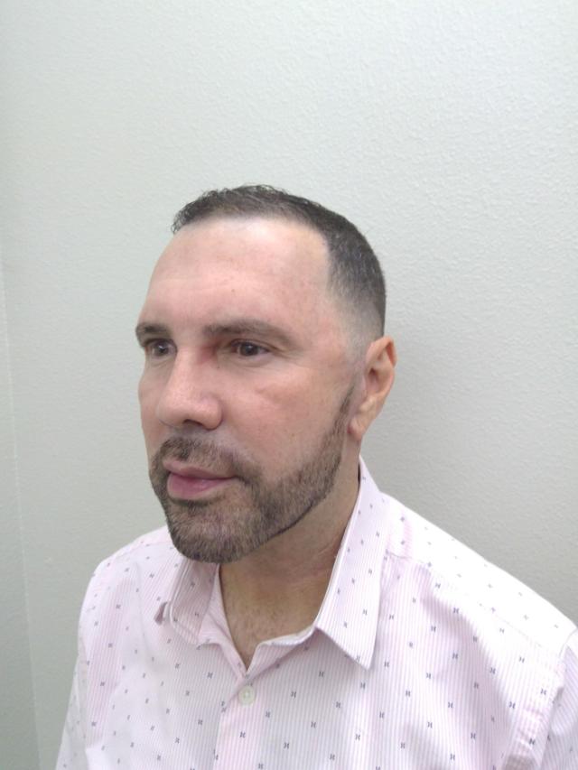 Neck Lift after at Plastic Surgery Central Florida in Orlando, FL