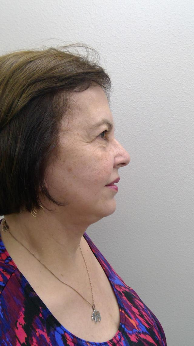 Deep Plane Facelift after at Plastic Surgery Central Florida in Orlando, FL