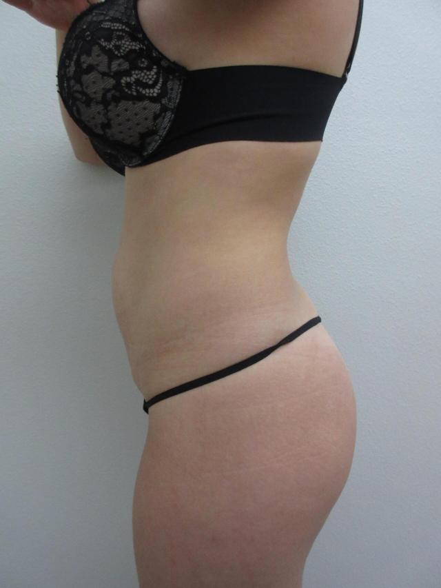 Brazilian Butt Lift before at Plastic Surgery Central Florida in Orlando, FL
