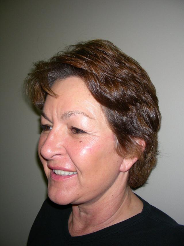 Deep Plane Facelift after at Plastic Surgery Central Florida in Orlando, FL