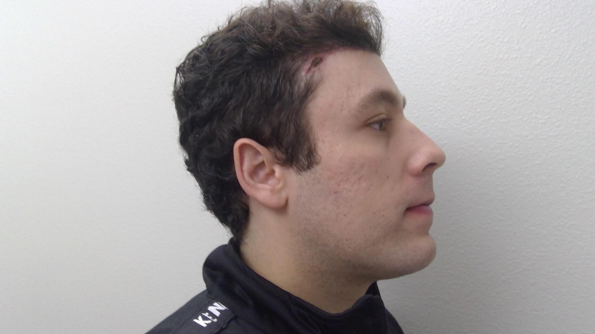 Plastic Surgery Central Florida chin implant after — Orlando, FL