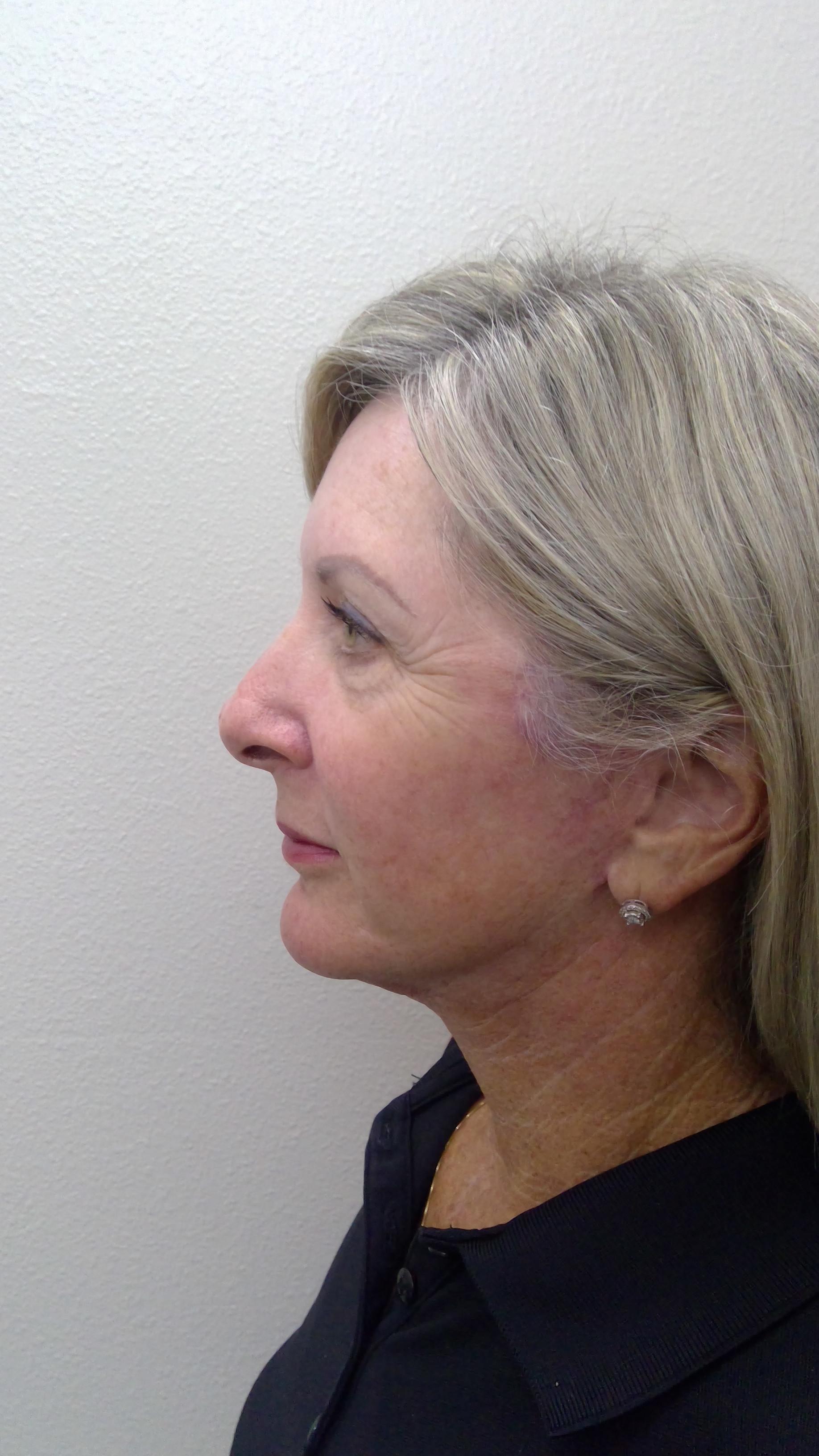 Plastic Surgery Central Florida chin implant after — Orlando, FL