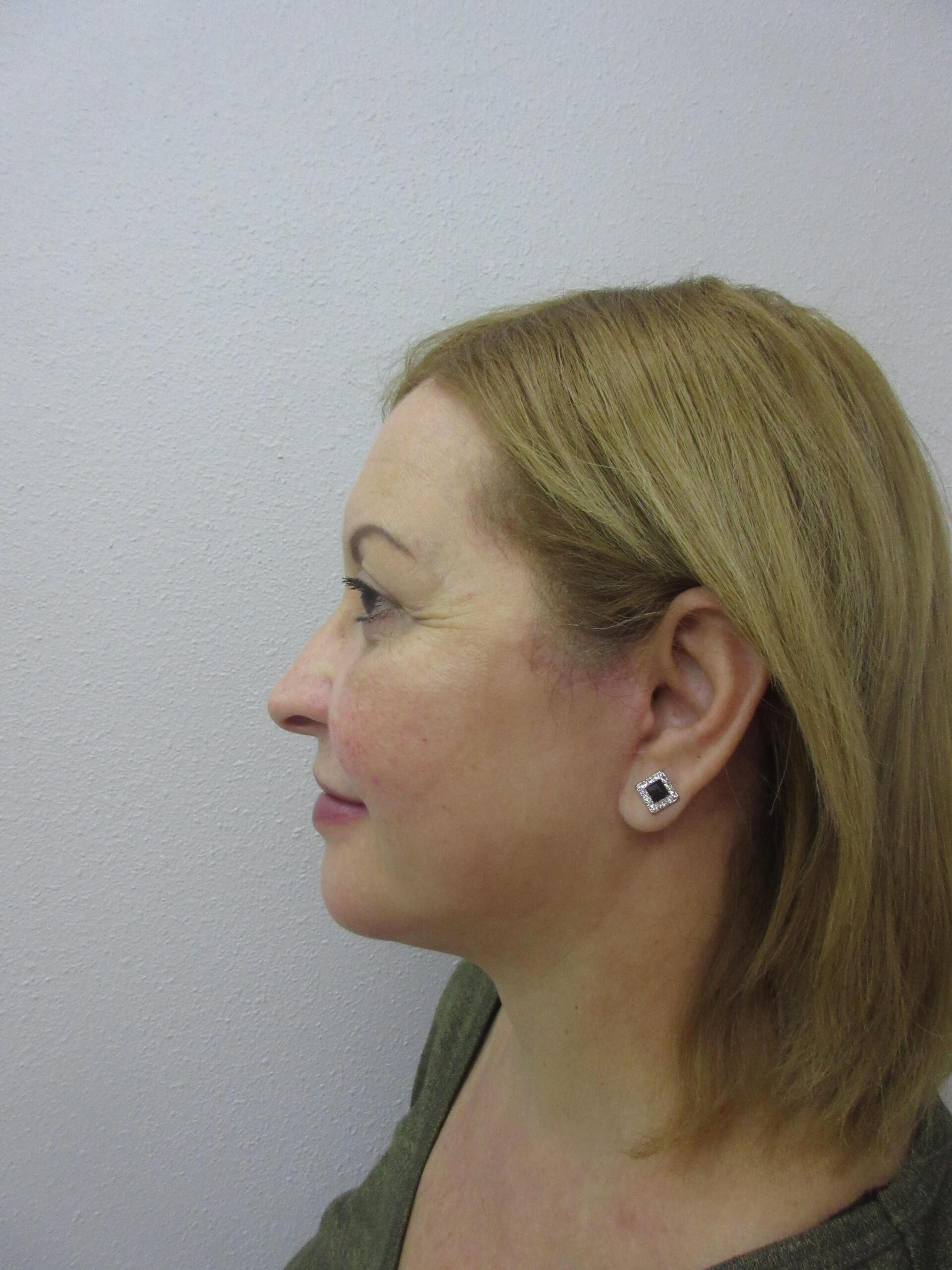 Plastic Surgery Central Florida chin implant after — Orlando, FL